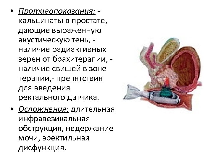  • Противопоказания: кальцинаты в простате, дающие выраженную акустическую тень, наличие радиактивных зерен от