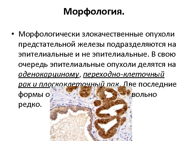 Морфология. • Морфологически злокачественные опухоли предстательной железы подразделяются на эпителиальные и не эпителиальные. В