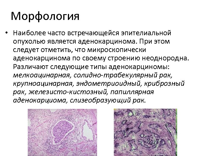 Морфология • Наиболее часто встречающейся эпителиальной опухолью является аденокарцинома. При этом следует отметить, что