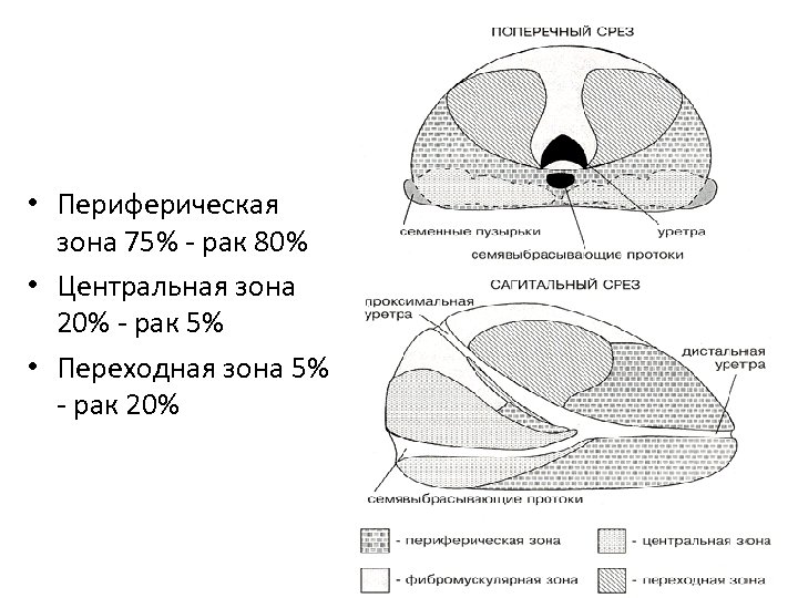  • Периферическая зона 75% - рак 80% • Центральная зона 20% - рак