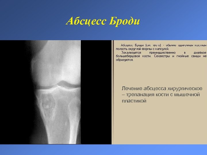 Абсцесс Броди Лечение абсцесса хирургическое – трепанация кости с мышечной пластикой 