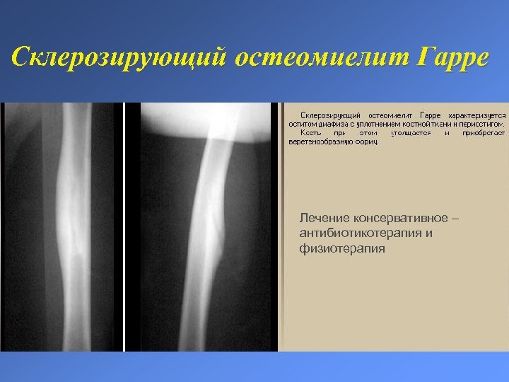 Склерозирующий остеомиелит Гарре Лечение консервативное – антибиотикотерапия и физиотерапия 