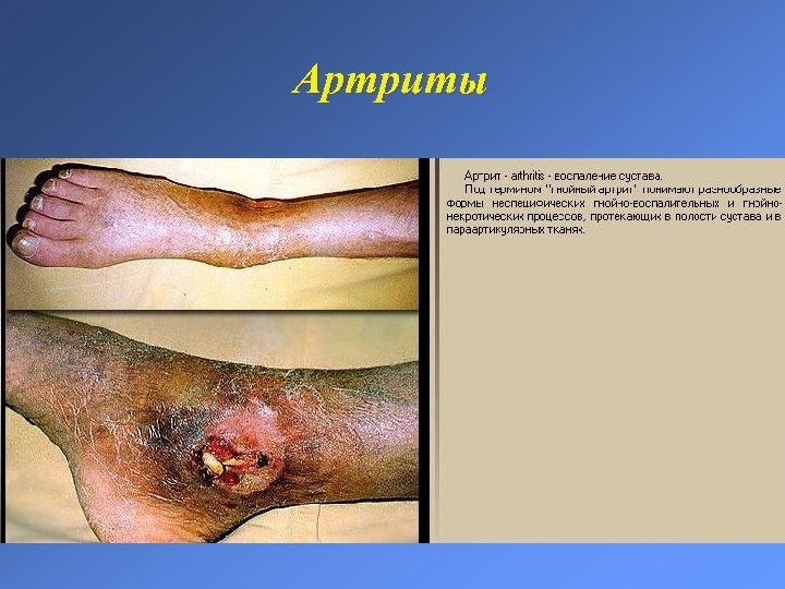 Артриты 