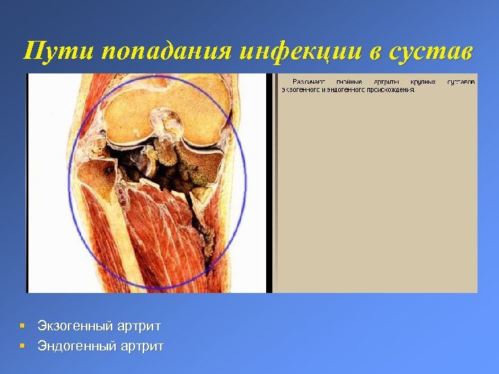 Пути попадания инфекции в сустав § Экзогенный артрит § Эндогенный артрит 