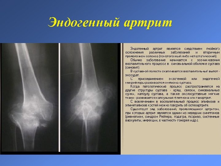 Эндогенный артрит 