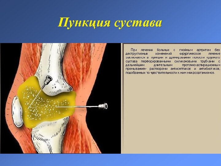 Пункция сустава 