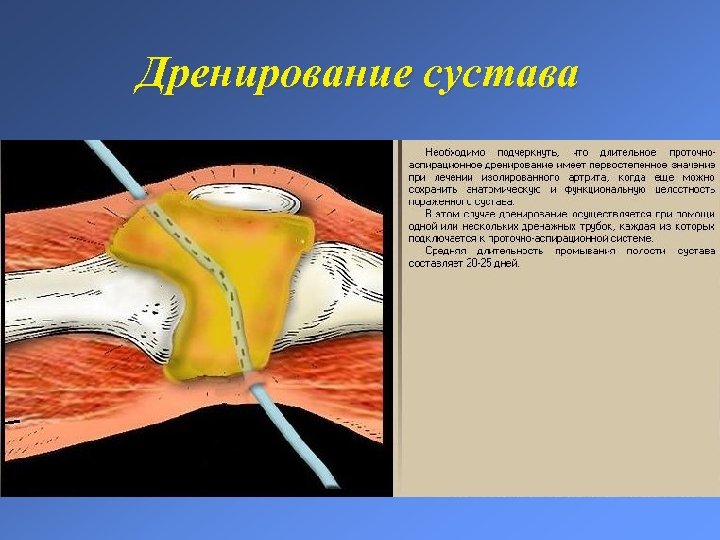 Дренирование сустава 