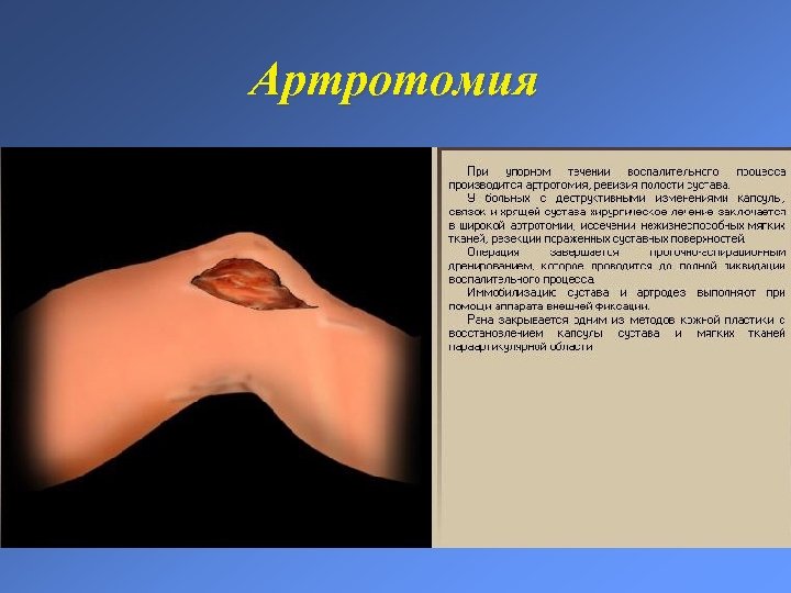 Артротомия 