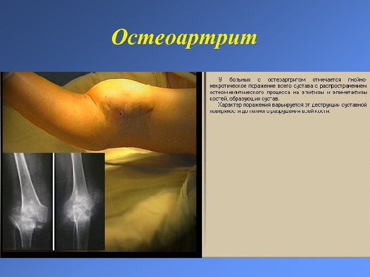 Остеоартрит 