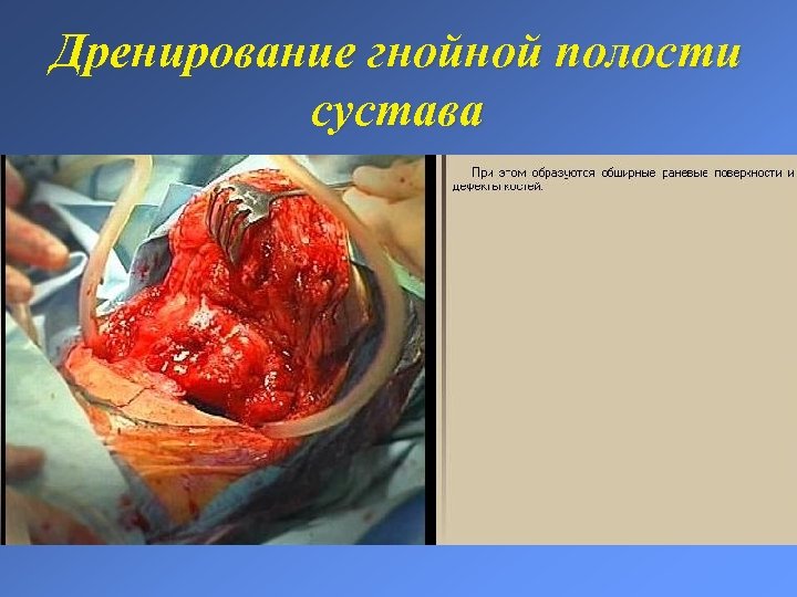 Дренирование гнойной полости сустава 