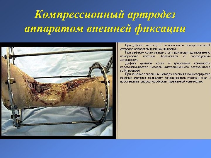 Компрессионный артродез аппаратом внешней фиксации 