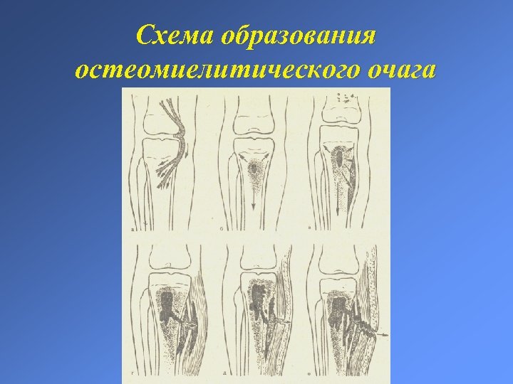 Схема образования остеомиелитического очага 