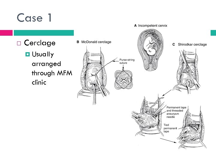 Case 1 Cerclage Usually arranged through MFM clinic 