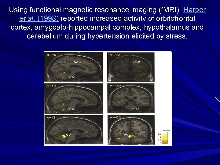 Using functional magnetic resonance imaging (f. MRI), Harper et al. (1998) reported increased activity