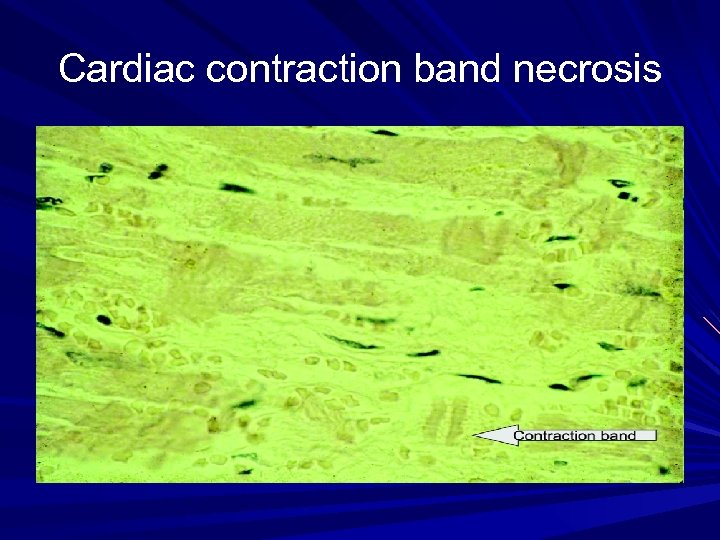 Cardiac contraction band necrosis 