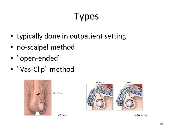 Types • • typically done in outpatient setting no-scalpel method 
