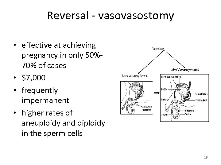 Reversal - vasostomy • effective at achieving pregnancy in only 50%70% of cases •