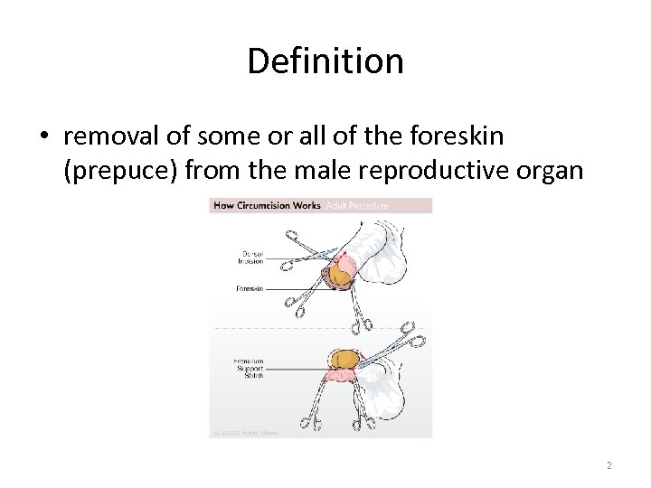 Definition • removal of some or all of the foreskin (prepuce) from the male