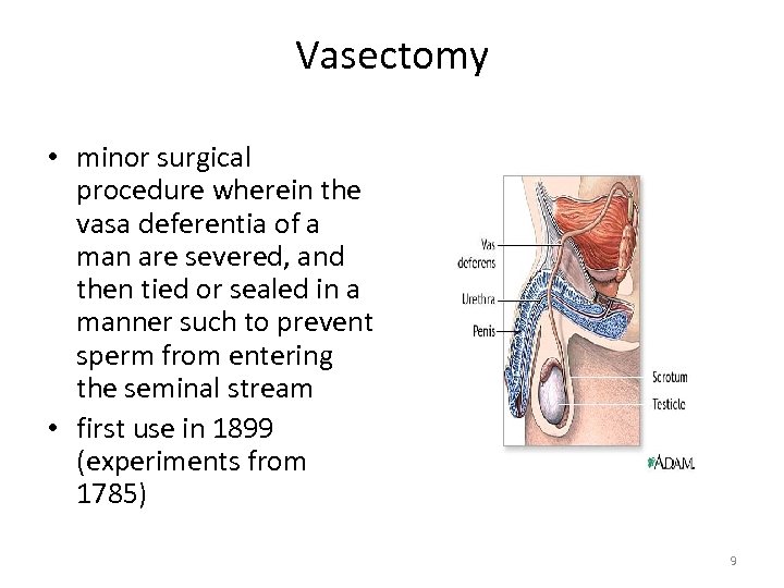 Vasectomy • minor surgical procedure wherein the vasa deferentia of a man are severed,