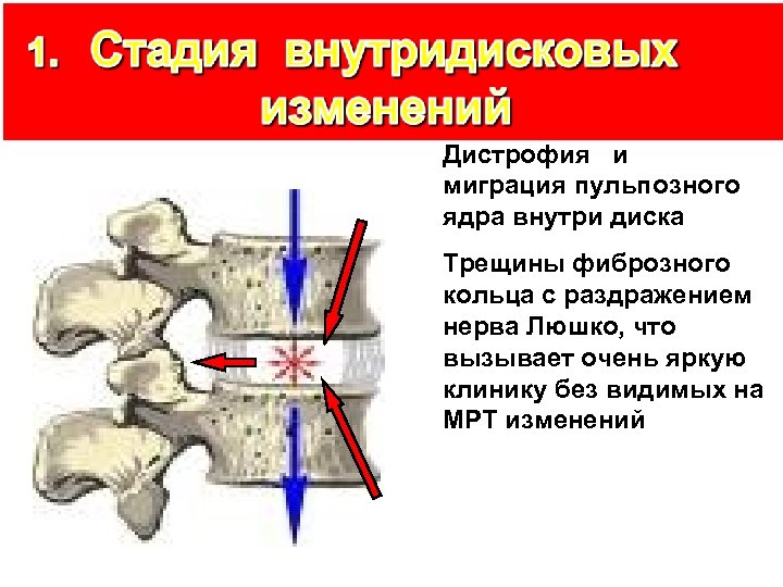 Дистрофия и миграция пульпозного ядра внутри диска Трещины фиброзного кольца с раздражением нерва Люшко,