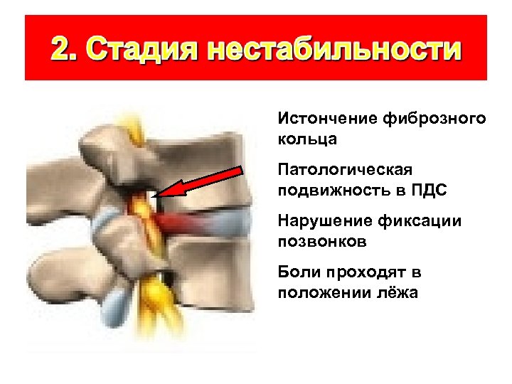 Истончение фиброзного кольца Патологическая подвижность в ПДС Нарушение фиксации позвонков Боли проходят в положении