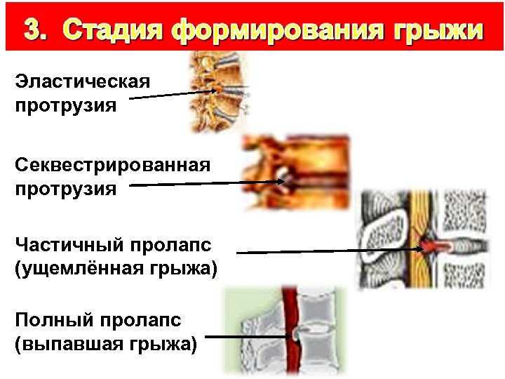 Эластическая протрузия Секвестрированная протрузия Частичный пролапс (ущемлённая грыжа) Полный пролапс (выпавшая грыжа) 