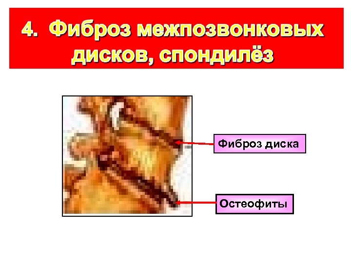 Фиброз диска Остеофиты 
