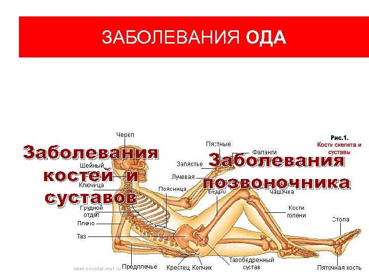 ЗАБОЛЕВАНИЯ ОДА Заболевания костей и суставов Заболевания позвоночника 