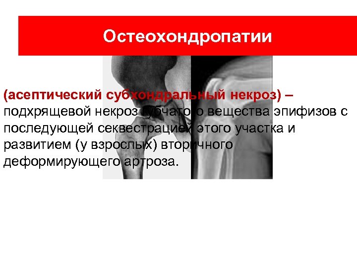 Остеохондропатии (асептический субхондральный некроз) – подхрящевой некроз губчатого вещества эпифизов с последующей секвестрацией этого