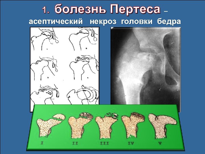 Классификация асептического некроза