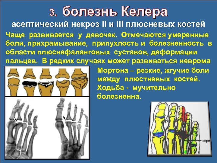 3. болезнь Келера асептический некроз II и III плюсневых костей Чаще развивается у девочек.