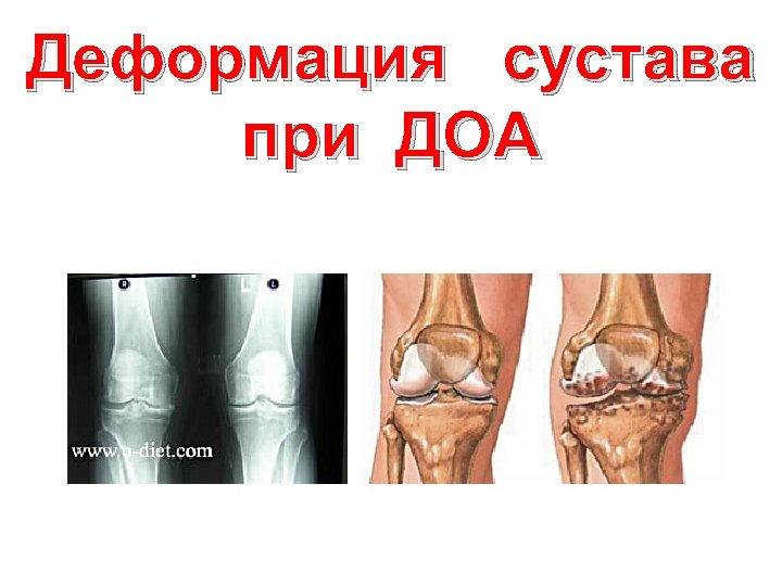 Деформация сустава при ДОА 