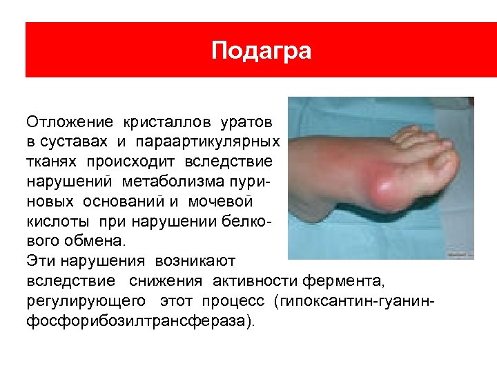 Подагра Отложение кристаллов уратов в суставах и параартикулярных тканях происходит вследствие нарушений метаболизма пуриновых