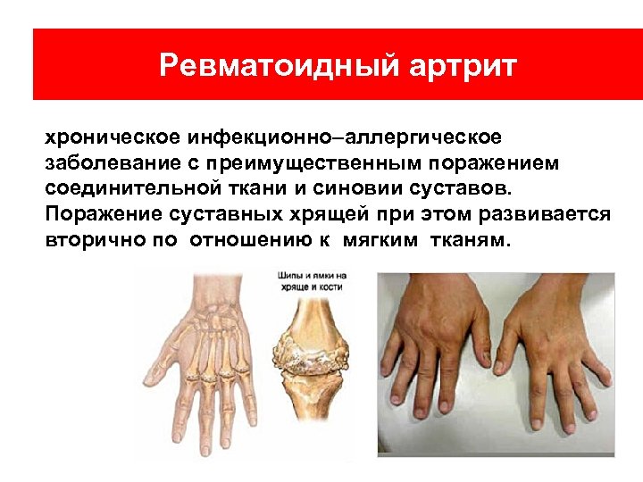 Ревматоидный артрит хроническое инфекционно–аллергическое заболевание с преимущественным поражением соединительной ткани и синовии суставов. Поражение