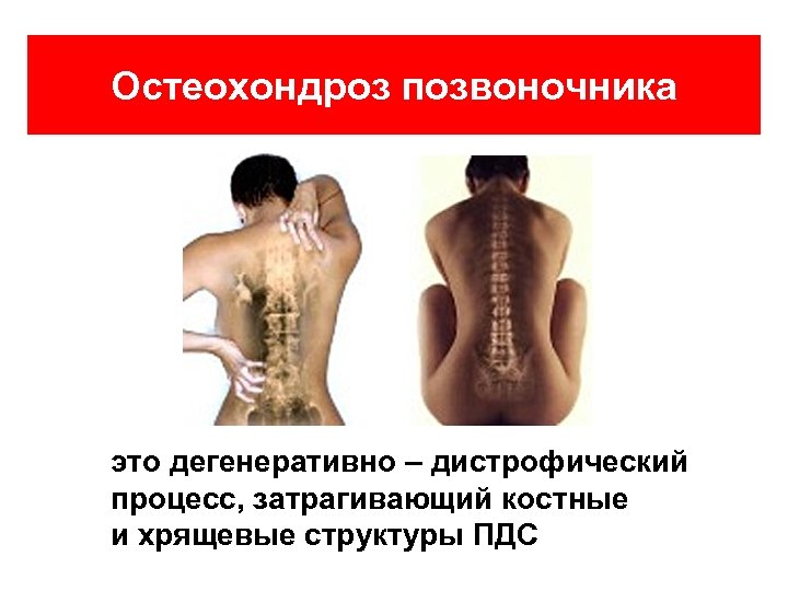 Остеохондроз позвоночника это дегенеративно – дистрофический процесс, затрагивающий костные и хрящевые структуры ПДС 