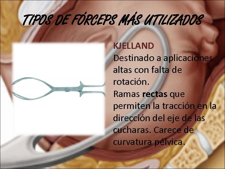 TIPOS DE FÓRCEPS MÁS UTILIZADOS KJELLAND Destinado a aplicaciones altas con falta de rotación.