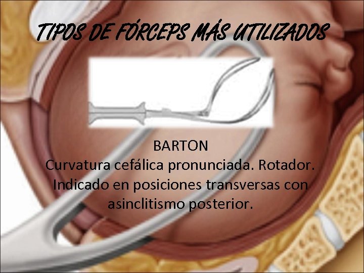 TIPOS DE FÓRCEPS MÁS UTILIZADOS BARTON Curvatura cefálica pronunciada. Rotador. Indicado en posiciones transversas