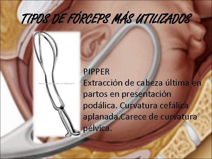 TIPOS DE FÓRCEPS MÁS UTILIZADOS PIPPER Extracción de cabeza última en partos en presentación