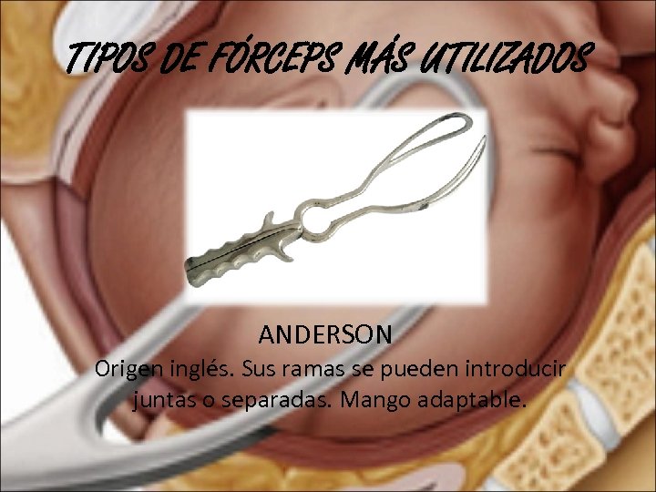 TIPOS DE FÓRCEPS MÁS UTILIZADOS ANDERSON Origen inglés. Sus ramas se pueden introducir juntas