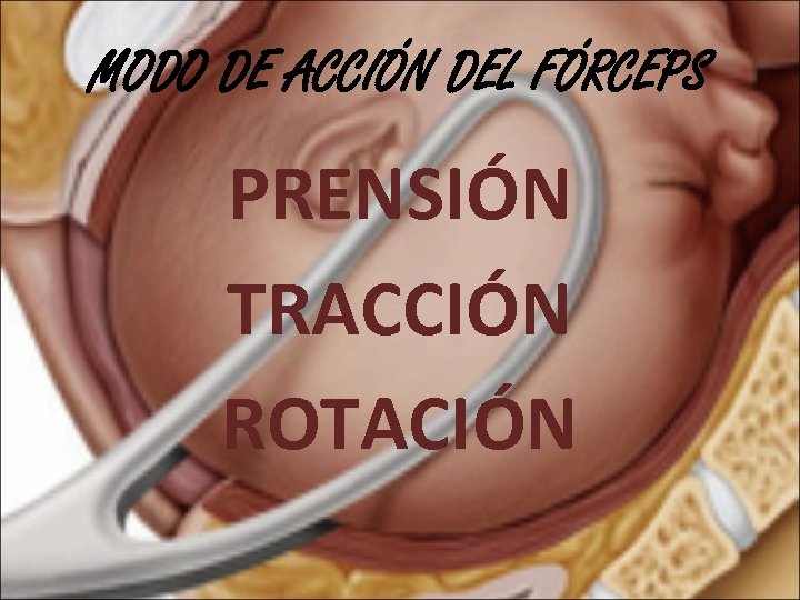 MODO DE ACCIÓN DEL FÓRCEPS PRENSIÓN TRACCIÓN ROTACIÓN 