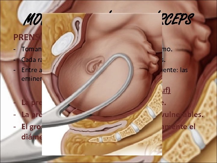 MODO DE ACCIÓN DEL FÓRCEPS PRENSIÓN: - Tomando la cabeza en el sentido de