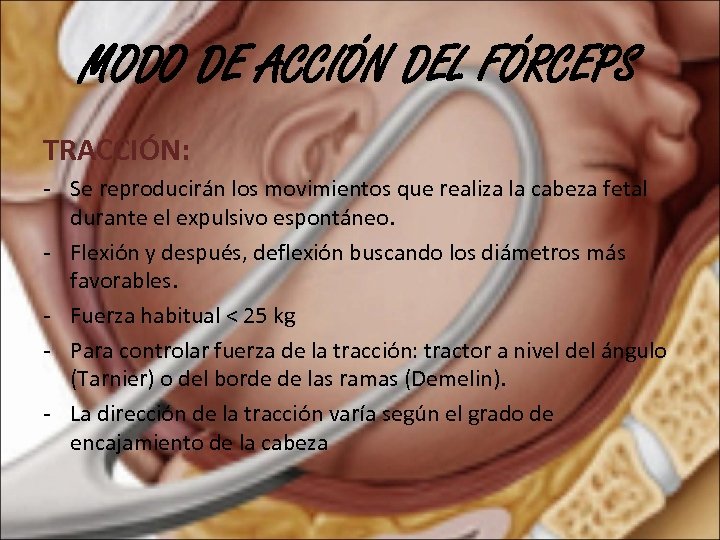 MODO DE ACCIÓN DEL FÓRCEPS TRACCIÓN: - Se reproducirán los movimientos que realiza la