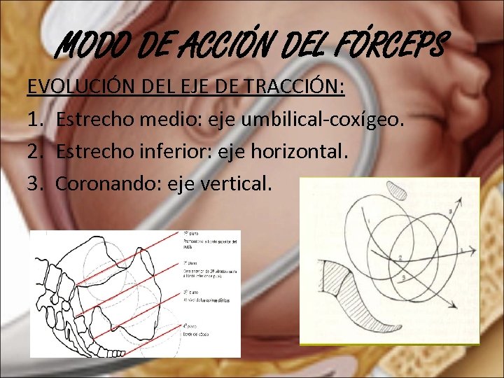 MODO DE ACCIÓN DEL FÓRCEPS EVOLUCIÓN DEL EJE DE TRACCIÓN: 1. Estrecho medio: eje