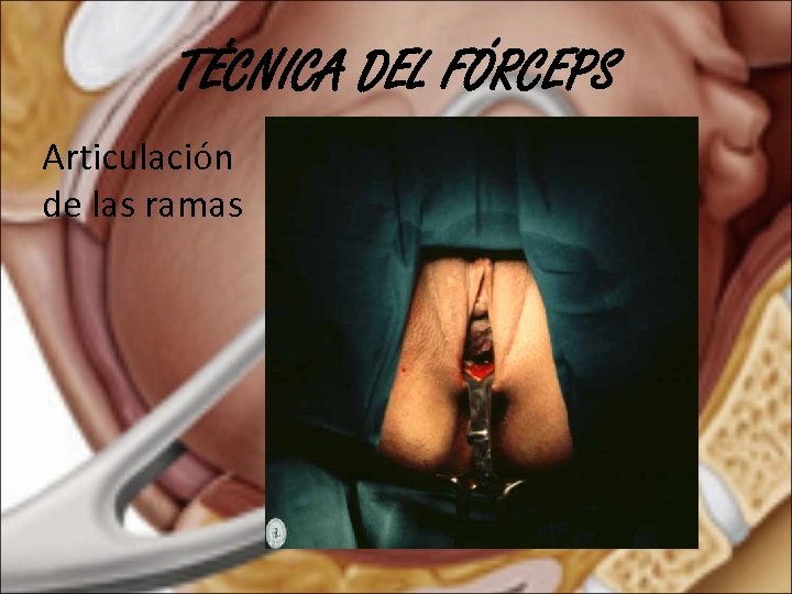 TÉCNICA DEL FÓRCEPS Articulación de las ramas 