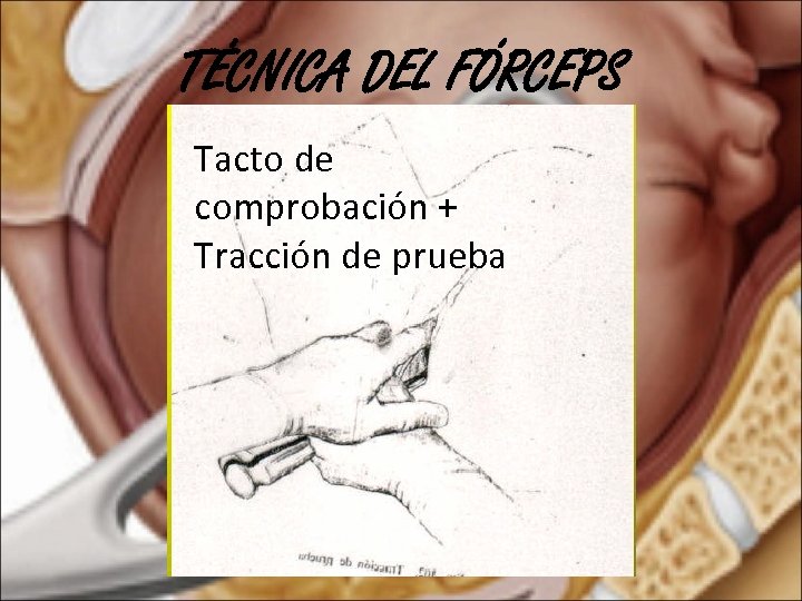 TÉCNICA DEL FÓRCEPS Tacto de comprobación + Tracción de prueba 