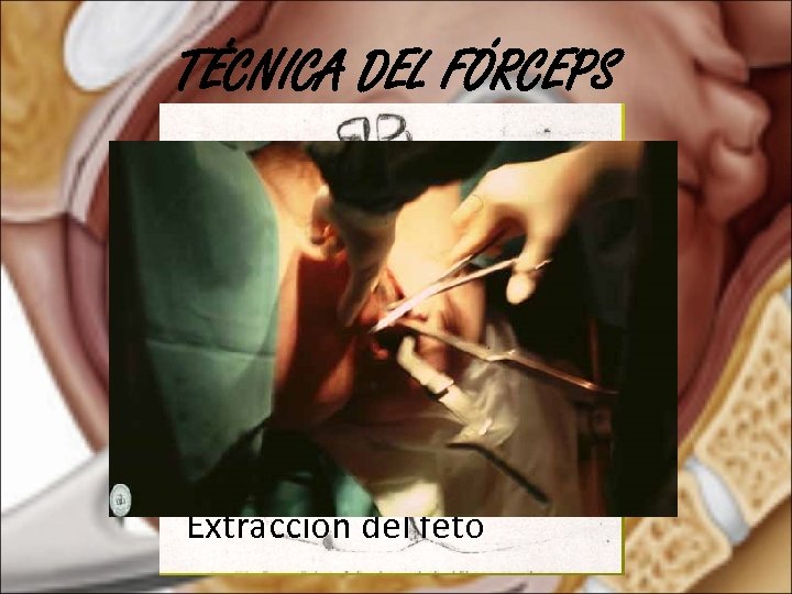 TÉCNICA DEL FÓRCEPS Extracción del feto 