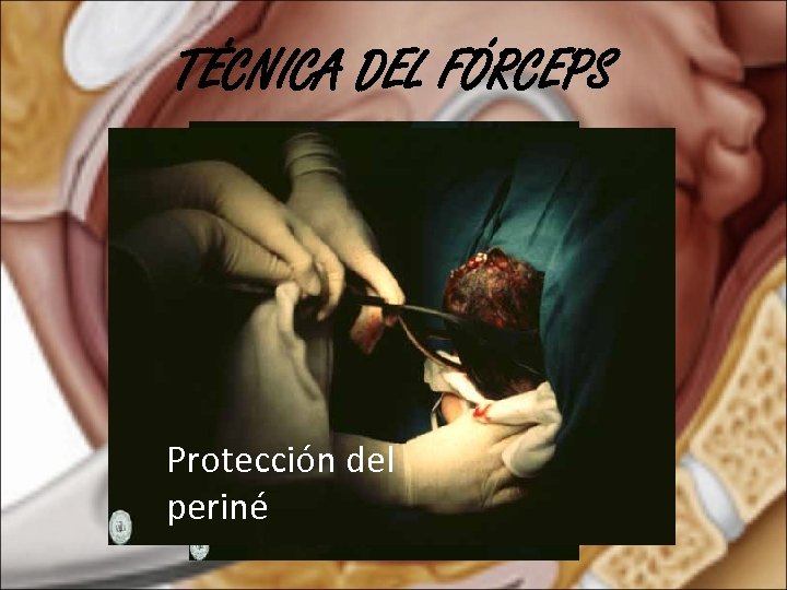 TÉCNICA DEL FÓRCEPS Protección del periné 