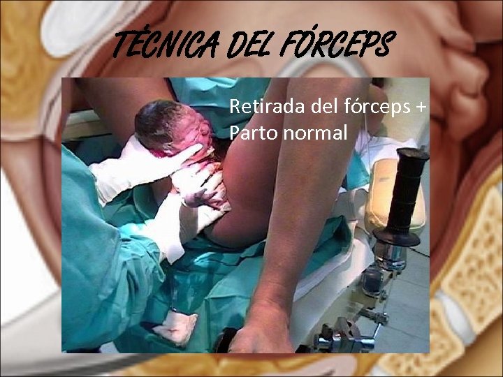 TÉCNICA DEL FÓRCEPS Retirada del fórceps + Parto normal 