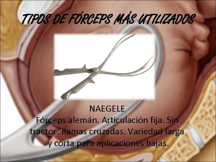 TIPOS DE FÓRCEPS MÁS UTILIZADOS NAEGELE Fórceps alemán. Articulación fija. Sin tractor. Ramas cruzadas.