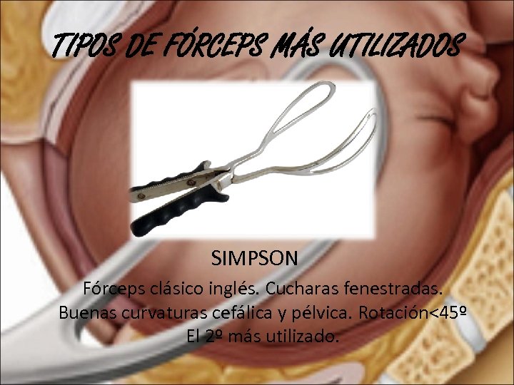 TIPOS DE FÓRCEPS MÁS UTILIZADOS SIMPSON Fórceps clásico inglés. Cucharas fenestradas. Buenas curvaturas cefálica